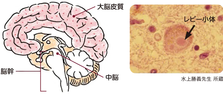 レビー小体型認知症の特徴