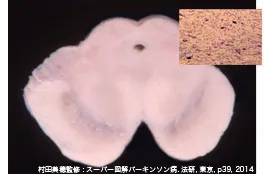 パーキンソン病の中脳